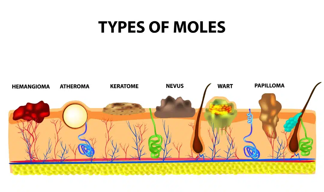 types of moles